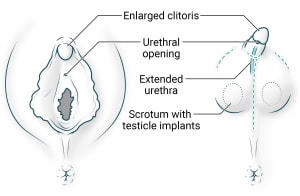 Enlarged clitoris and vulva anatomy are used to create a small penis and scrotum with testicle implants. The urethra is extended up and the opening moves towards the new penis head.