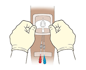 Arm with midline catheter, showing gloved hands placing clean dressing over catheter and insertion site with tape securing two lines to skin.