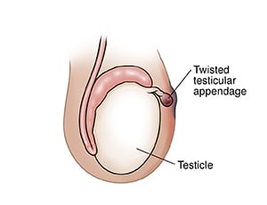 Side view of testicle in scrotum, showing twisted testicular appendage.