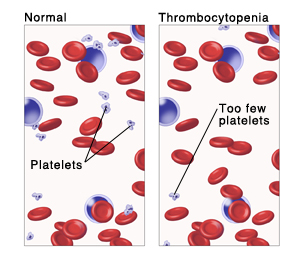 Microscopic view of blood with normal amount of platelets. Microscopic view of blood with too few platelets.