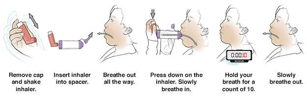 Six steps in using metered-dose inhaler with a spacer.
