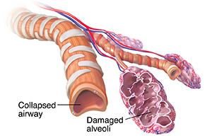 Collapsed bronchiole and alveolar sacs with emphysema.