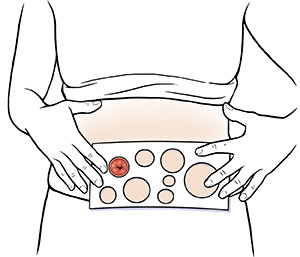 Female abdomen showing hands holding measuring guide to stoma.