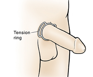 Tension ring around base of penis.