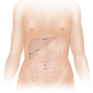 Outline of woman showing lower digestive tract and liver. Lines indicate incisions for laparoscopic gallbladder surgery.