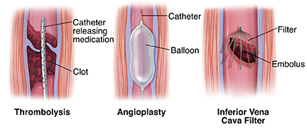 Three ways to treat venous thrombosis: catheter delivering medication, balloon angioplasty, embolus filter.