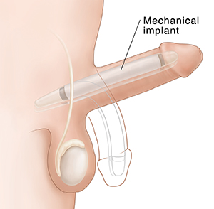 Side view of penis with malleable implant in place, outline shows relaxed position.
