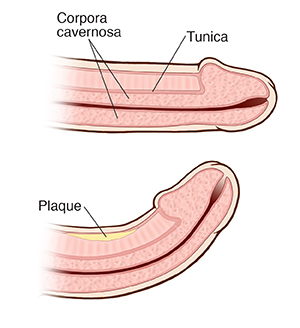 Cross section of normal penis. Cross section of curved penis with Peyronie disease.
