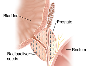 Cross section of a prostate showing radioactive seeds for interstitial brachytherapy.