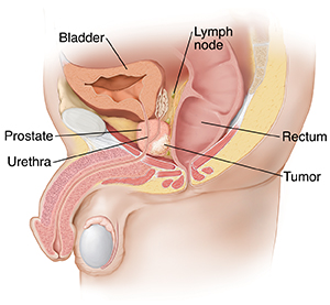 Side view of male pelvic organs showing tumor in prostate.