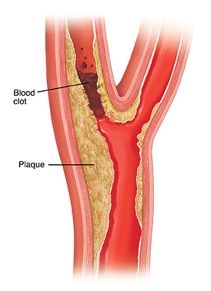 Cross section of carotid artery showing plaque buildup and blood clot.