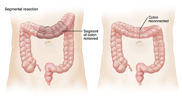 Outline of adult abdomen showing large and small intestines. Shaded area on transverse colon shows segmental resection. Outline of adult abdomen showing ends of transverse colon reattached after segmental resection.