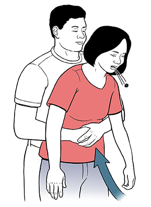 Man standing behind woman with arms around her waist and fist at her upper abdomen, with other hand flat on fist. Arrow shows him pressing in and up with his fist. Blockage is being expelled from woman's mouth.