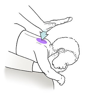 Closeup of adult holding infant face down on lap, preparing to strike between shoulderblades with heel of hand.