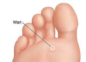 Sole of foot showing a plantar wart.