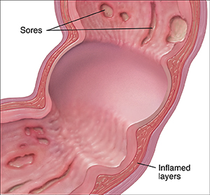 Cross section of colon showing sores and inflamed layers from Crohn's disease.