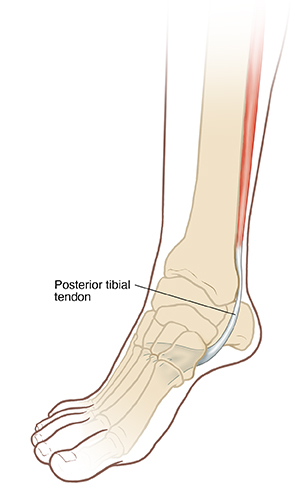 Three-quarter view of lower leg and foot showing bones and posterior tibial tendon.