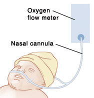 image of a baby's head, with nasal cannula