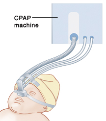 image of CPAP device over baby's nose