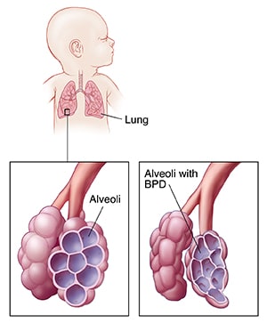 Lungs in newborn's chest, with detail of normal alveoli and of alveoli with bronchopulmonary dysplasia (BPD).