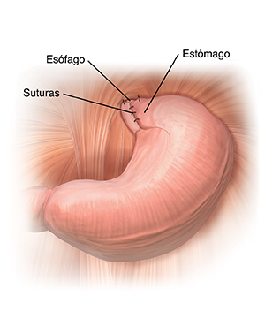 Primer plano de la parte inferior del esófago con la parte superior del estómago envuelta a su alrededor y sujetada con puntos.