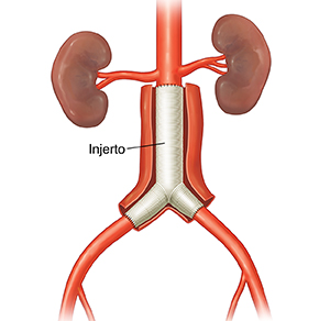 Cirugía abierta para colocar injerto para aneurisma aórtico abdominal.