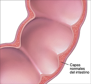 Corte transversal del colon en donde se muestran las capas normales de la pared intestinal.