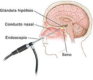 Vista lateral de la cabeza y el cerebro que muestra un endoscopio que pasa por la nariz y los senos paranasales y que brilla sobre la hipófisis.