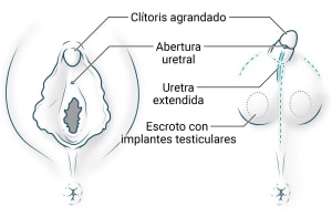 La anatomía ampliada del clítoris y la vulva se utiliza para crear un pene pequeño y un escroto con implantes testiculares. La uretra se prolonga hacia arriba y la abertura se desplaza hacia la nueva cabeza del pene.