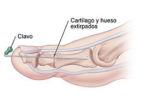 Vista lateral de un dedo del pie donde se observa la fijación del clavo y la fusión.