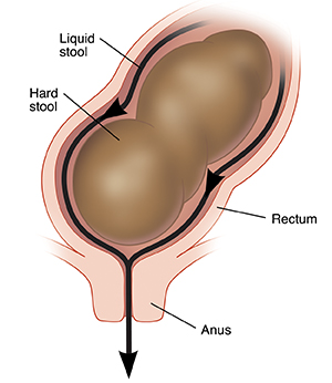 Close-up cross section of rectum and anus showing liquid stool leaking around hard stool.
