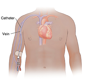Front view of chest showing midline catheter inserted in vein just above elbow.