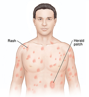 Front view of head and chest showing pityriasis rosea.