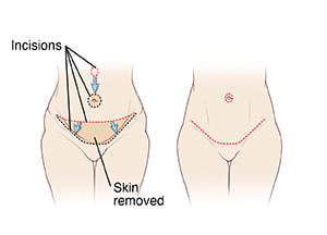 Abdominoplasty incisions to remove skin and move navel, and final result showing closed incisions.