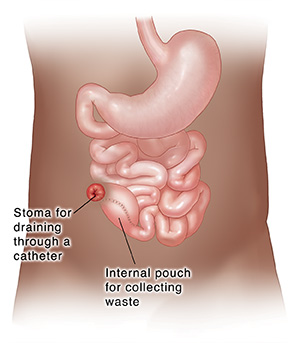 Front view of lower digestive tract with colon and rectum removed, showing stoma and pouch for continent ileostomy. 