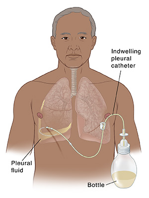 Male upper body and lungs showing catheter attached to a drainage bottle and inserted under skin into fluid-filled right pleural cavity.
