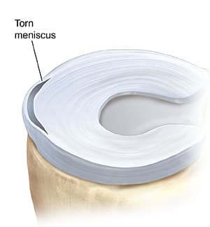Top view of meniscus showing showing peripheral tear.