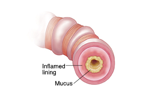 An inflamed airway blocks airflow.