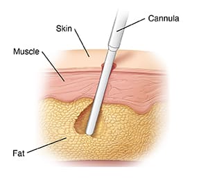 Skin layers showing cannula removing fat during liposuction.