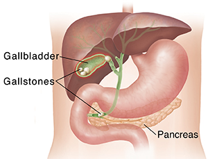 Outline of torso showing liver and stomach with cross section of gallbladder with stones.