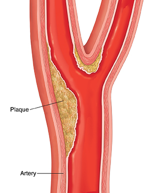 Cross section of carotid artery showing plaque buildup. 