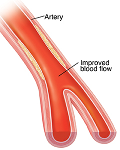 Cross-section of artery with plaque showing compressed plaque after balloon angioplasty.