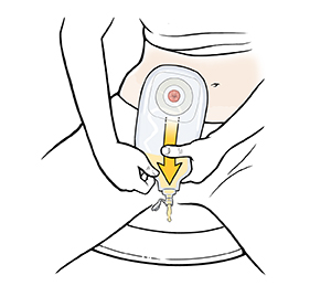 Woman sitting on toilet emptying urostomy pouch into toilet.