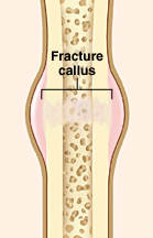 Cross section of broken bone showing callus forming at break.