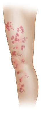 Side view of a leg with a patchy rash from thigh to calf on light skin.