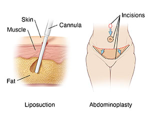 Abdominoplasty, showing incisions, and liposuction cannula removing fat below skin and muscle.