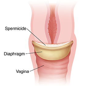 Diaphragm with spermicide in place on cervix.