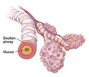 Bronchiole and alveolar sacs with mucus buildup and inflammation because of chronic bronchitis.