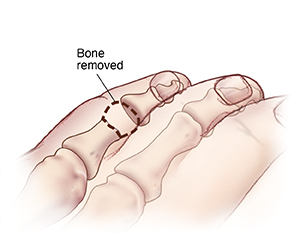 Top view of curled fifth toe with dotted line showing bone removed for derotation arthroplasty.