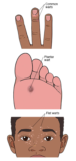 Warts on darker skin: Common warts on end of finger, plantar wart on sole of foot, and flat warts on face.